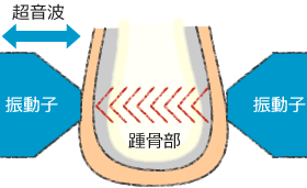 超音波骨密度測定装置　測定　イメージ